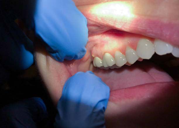 Tooth Infection Emergency Dentist in AL